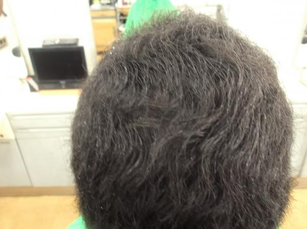 20代の発毛後　上の髪