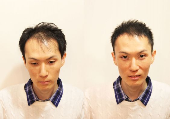 髪の毛の少ない方　多く見せる画期的なカット