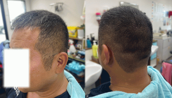 5mm刈り上げ(らくちんセット不要)